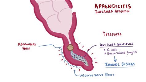 What Causes Subacute Appendicitis